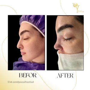 راهنمای جامع هزینه جراحی بینی در مازندران سال ۱۴۰۳ (و پیش‌بینی