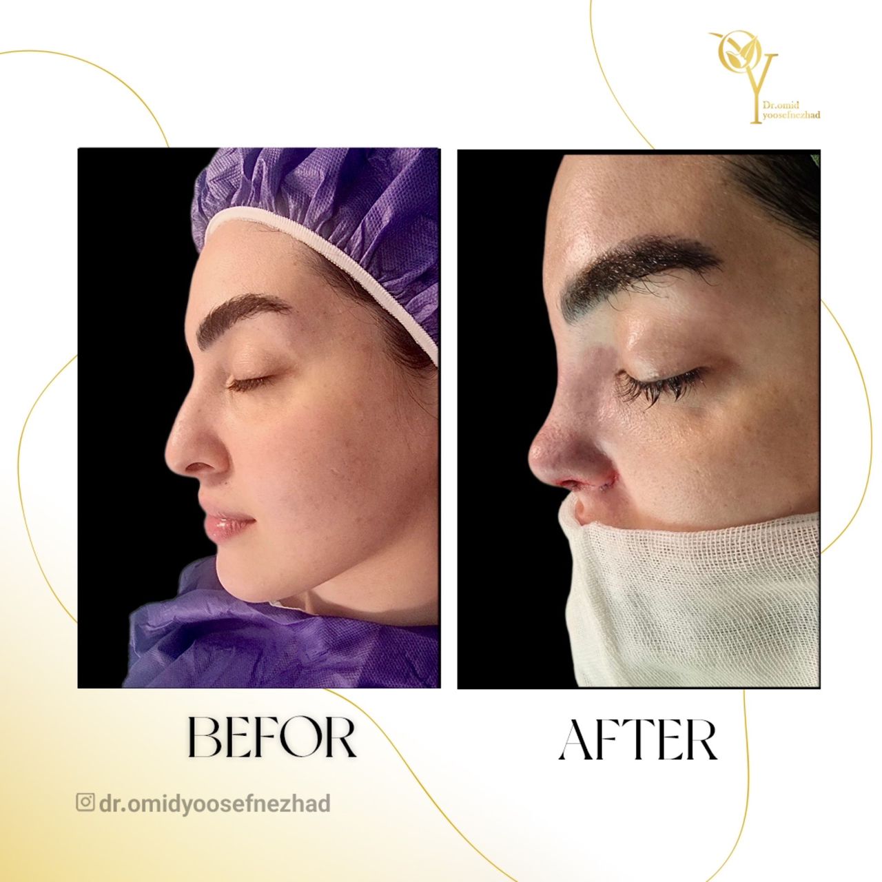 راهنمای جامع هزینه جراحی بینی در مازندران سال ۱۴۰۳ (و پیش‌بینی