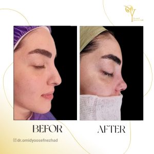 جراحی زیبایی بینی در مازندران