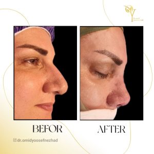 جراحی زیبایی بینی در مازندران