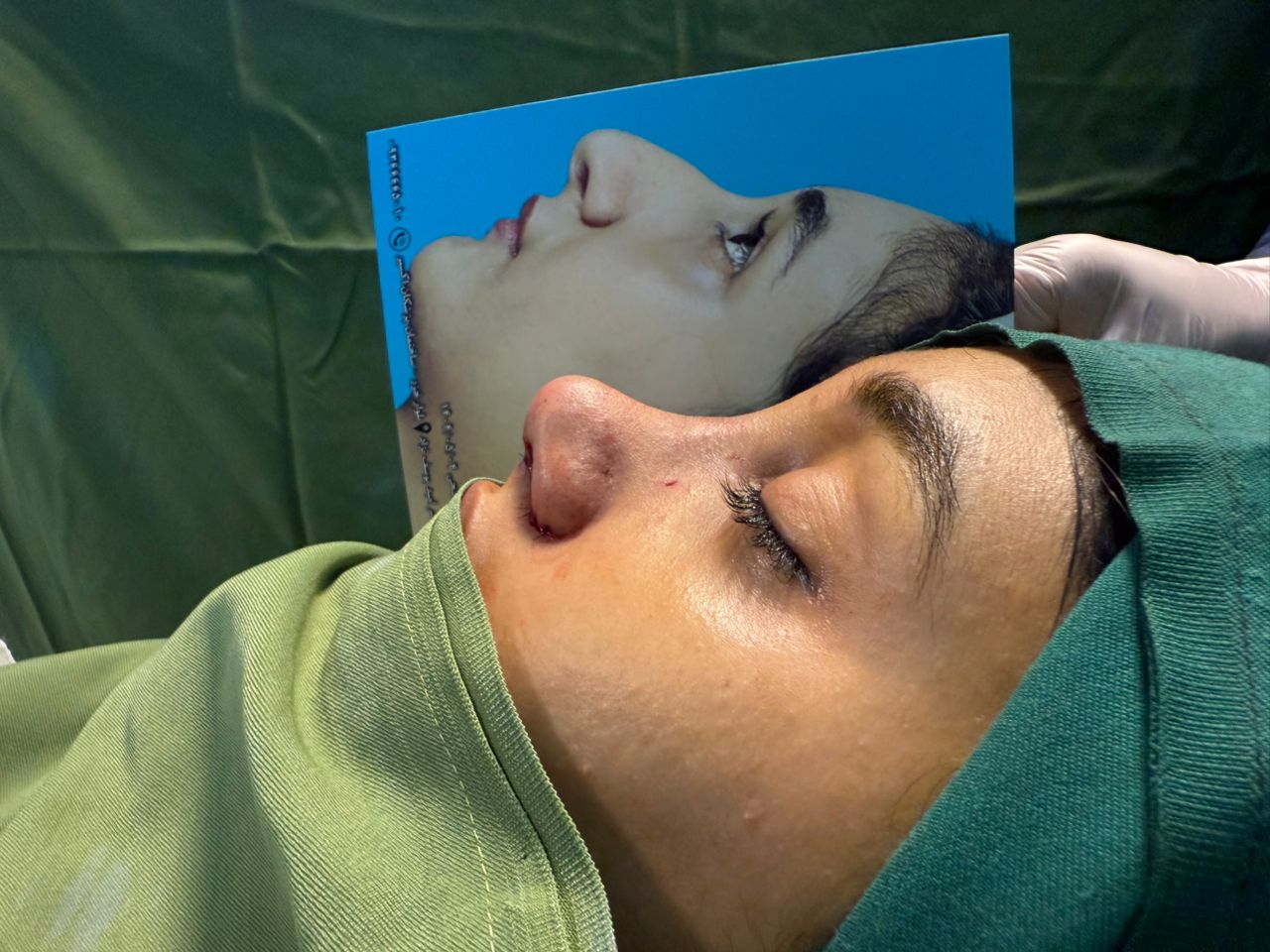 جراحی زیبایی بینی در مازندران