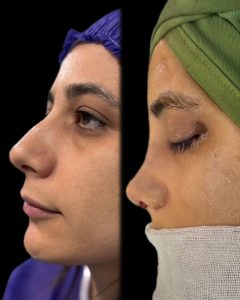 جراحی زیبایی بینی در مازندران