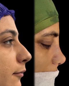 جراحی زیبایی بینی در مازندران