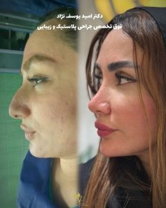 جراحی زیبایی بینی در مازندران