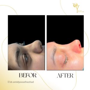 جراحی زیبایی بینی در مازندران