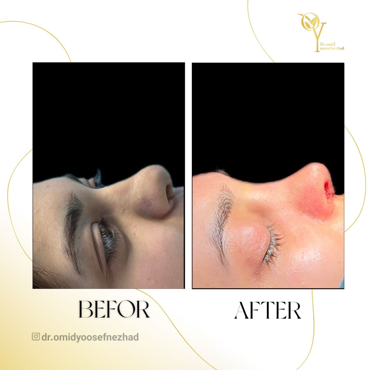 جراحی زیبایی بینی در مازندران