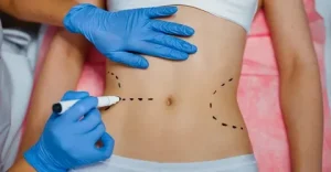 ابدومینوپلاستی در مازندران