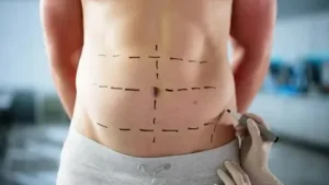 ابدومینوپلاستی در مازندران