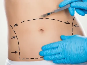 ابدومینوپلاستی در مازندران