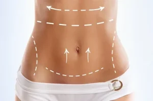 ابدومینوپلاستی در بابل