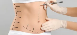 ابدومینوپلاستی در ساری